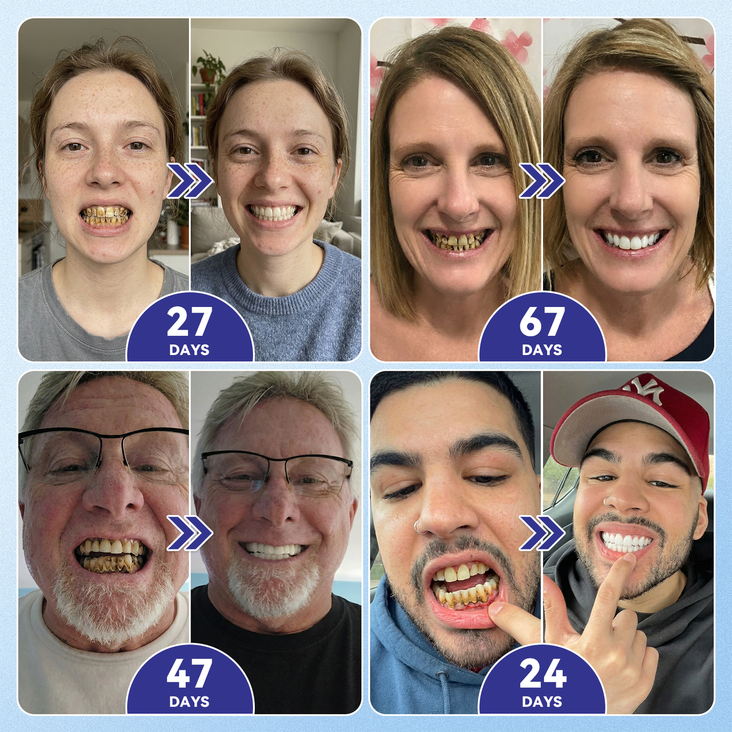 🦷𝐆𝐥𝐢𝐦𝐦𝐞𝐫𝐥𝐲® 𝐓𝐢𝐝𝐞𝐠𝐥𝐮𝐬𝐢𝐛 𝐓𝐨𝐨𝐭𝐡 & 𝐆𝐮𝐦 𝐑𝐞𝐩𝐚𝐢𝐫 𝐌𝐢𝐜𝐫𝐨𝐧𝐞𝐞𝐝𝐥𝐞 𝐏𝐚𝐭𝐜𝐡  | 𝐀𝐝𝐯𝐚𝐧𝐜𝐞𝐝 𝐒𝐭𝐞𝐦-𝐂𝐞𝐥𝐥 𝐀𝐜𝐭𝐢𝐯𝐚𝐭𝐢𝐨𝐧 𝐓𝐞𝐞𝐭𝐡 𝐒𝐭𝐫𝐢𝐩𝐬(🦷𝐑𝐞𝐛𝐮𝐢𝐥𝐝 𝐄𝐧𝐚𝐦𝐞𝐥 & 𝐃𝐞𝐧𝐭𝐢𝐧 • 𝐒𝐭𝐫𝐞𝐧𝐠𝐭𝐡𝐞𝐧 𝐆𝐮𝐦𝐬 • 𝐄𝐫𝐚𝐝𝐢𝐜𝐚𝐭𝐞 𝐓𝐚𝐫𝐭𝐚𝐫 & 𝐎𝐝𝐨𝐫 • 𝐒𝐭𝐨𝐩 𝐓𝐨𝐨𝐭𝐡 𝐒𝐞𝐧𝐬𝐢𝐭𝐢𝐯𝐢𝐭𝐲)